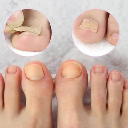 Adesivo para Unhas | Fungos e Unhas Encravadas | 32 Un - imagem 5